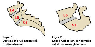 Smerter og omkring lænden